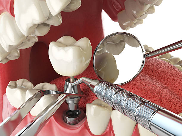 Best Emergency Tooth Extraction in West Yellowstone, MT
